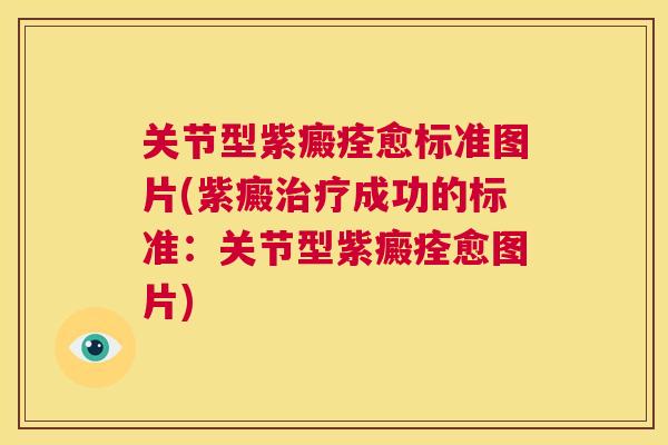 关节型紫癜痊愈标准图片(紫癜治疗成功的标准：关节型紫癜痊愈图片)