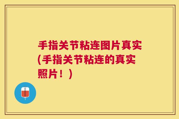 手指关节粘连图片真实(手指关节粘连的真实照片！)