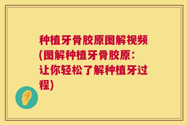 种植牙骨胶原图解视频(图解种植牙骨胶原：让你轻松了解种植牙过程)